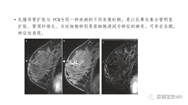 影像PPT - 【PPT】浆细胞性乳腺炎的MRI诊断-11