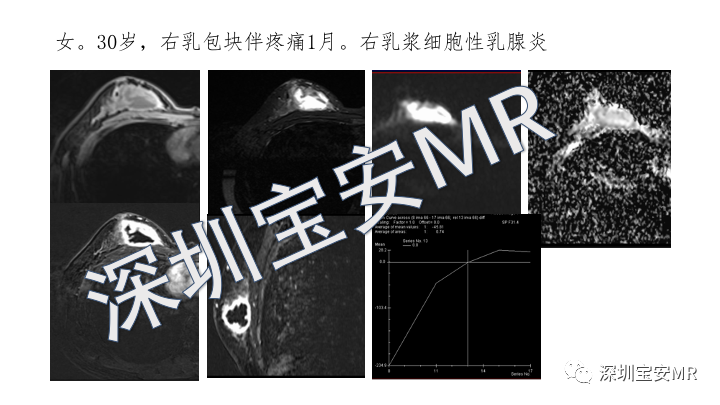 影像PPT - 【PPT】浆细胞性乳腺炎的MRI诊断-12