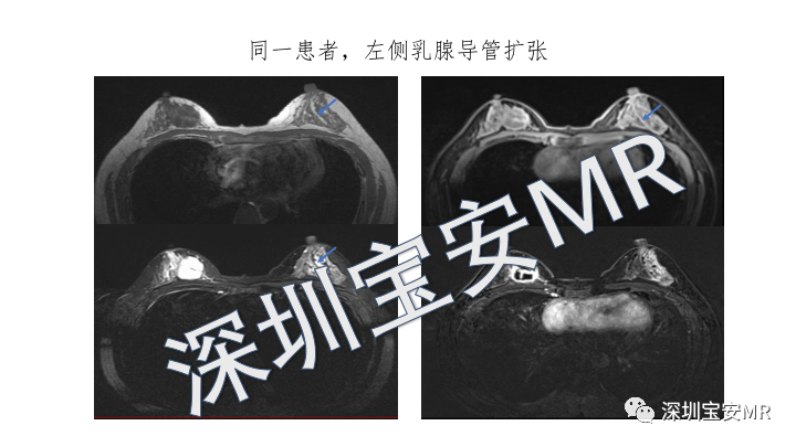 影像PPT - 【PPT】浆细胞性乳腺炎的MRI诊断-13