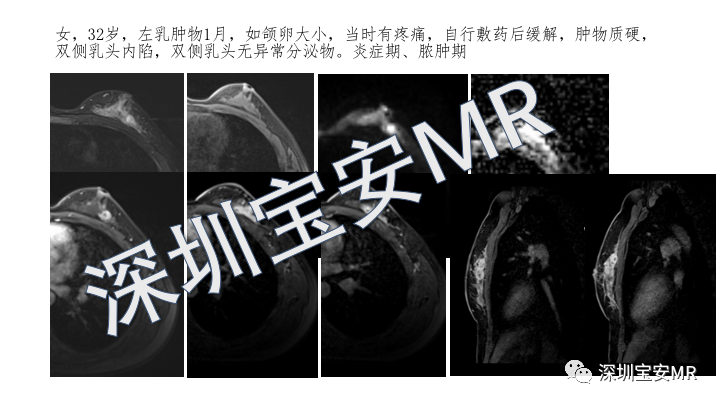 影像PPT - 【PPT】浆细胞性乳腺炎的MRI诊断-14