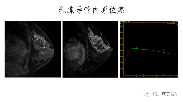 影像PPT - 【PPT】浆细胞性乳腺炎的MRI诊断-17
