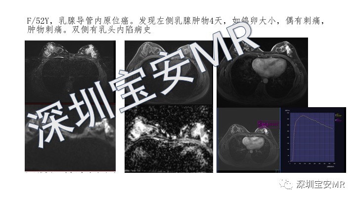 影像PPT - 【PPT】浆细胞性乳腺炎的MRI诊断-18