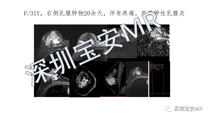 影像PPT - 【PPT】浆细胞性乳腺炎的MRI诊断-19