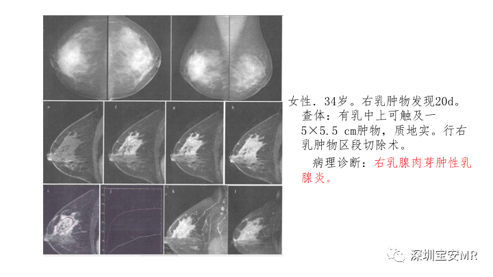 影像PPT - 【PPT】浆细胞性乳腺炎的MRI诊断-20