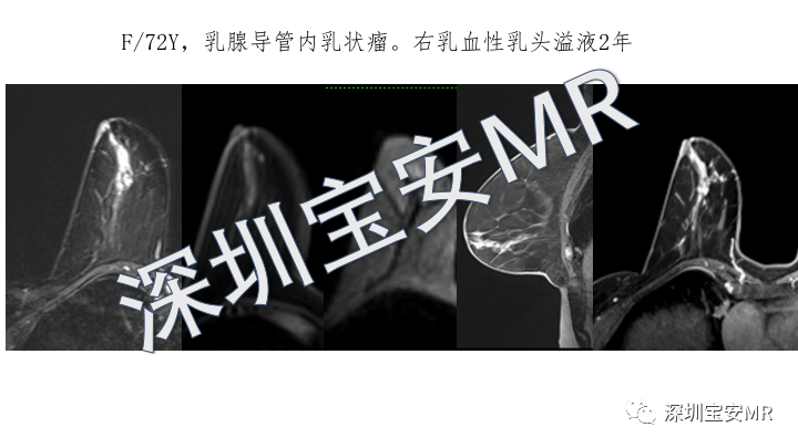 影像PPT - 【PPT】浆细胞性乳腺炎的MRI诊断-21