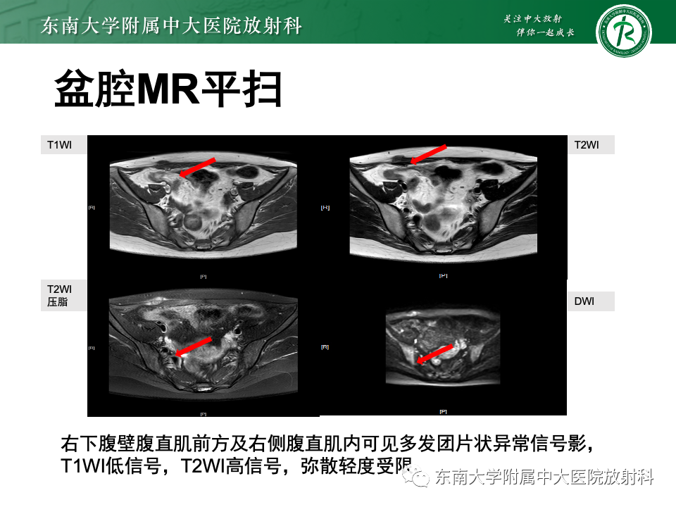 影像PPT - 【PPT】子宫内膜异位症-3