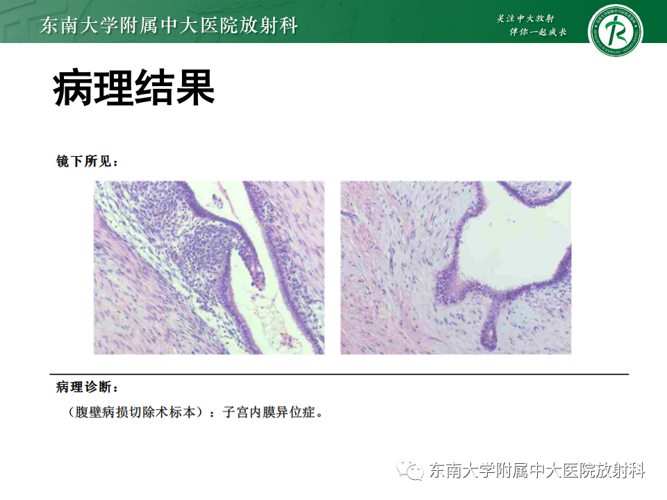 影像PPT - 【PPT】子宫内膜异位症-4