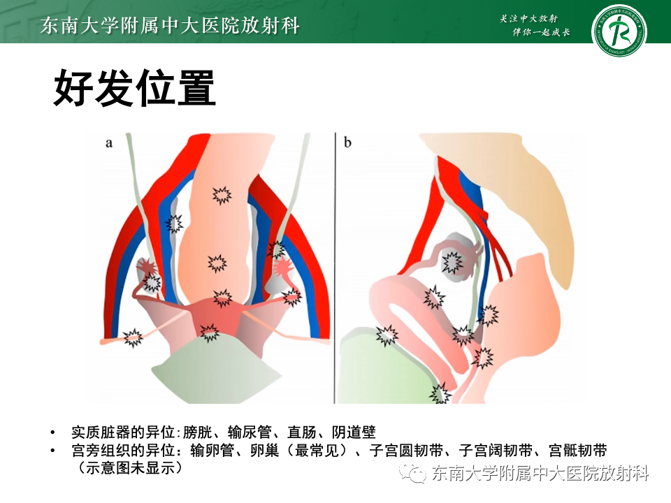 影像PPT - 【PPT】子宫内膜异位症-8