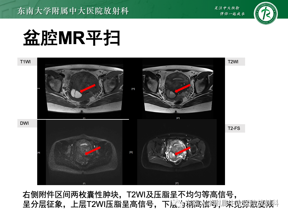 影像PPT - 【PPT】子宫内膜异位症-18