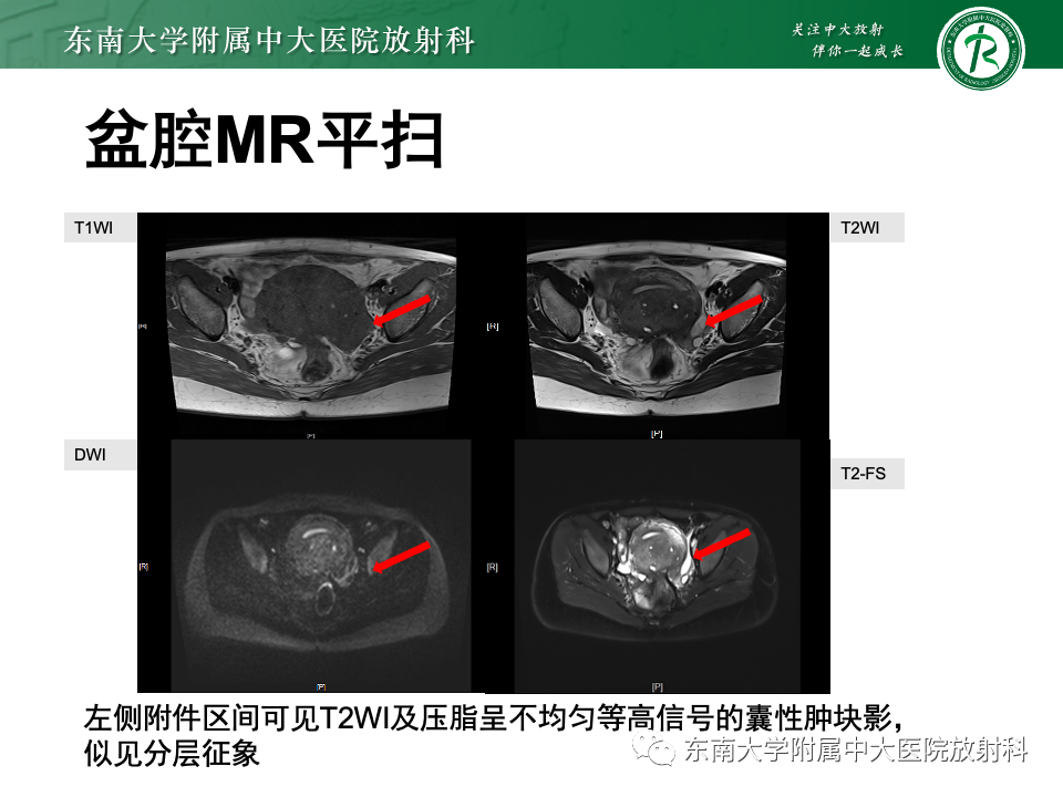 影像PPT - 【PPT】子宫内膜异位症-19