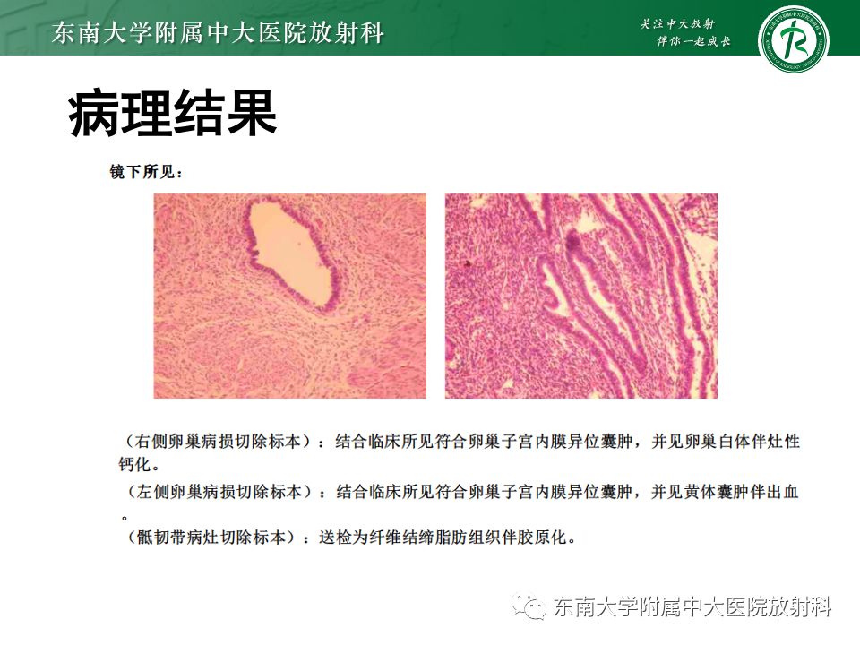 影像PPT - 【PPT】子宫内膜异位症-20