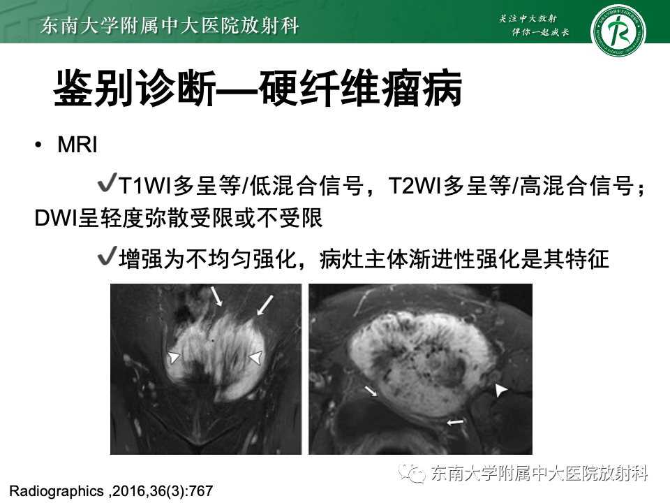 影像PPT - 【PPT】子宫内膜异位症-27