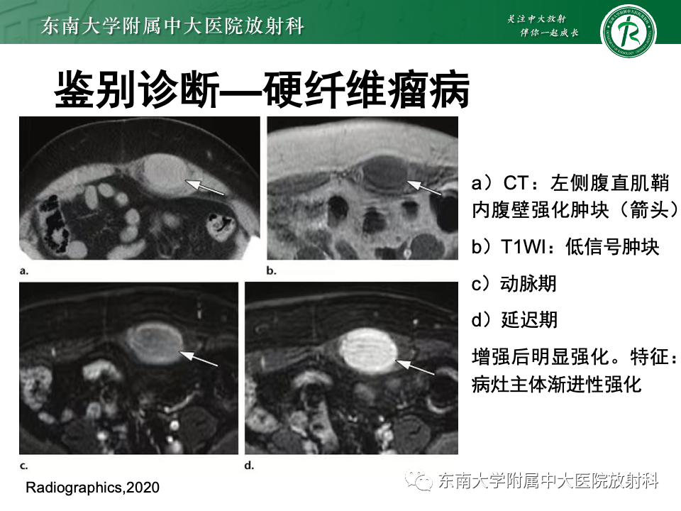 影像PPT - 【PPT】子宫内膜异位症-28