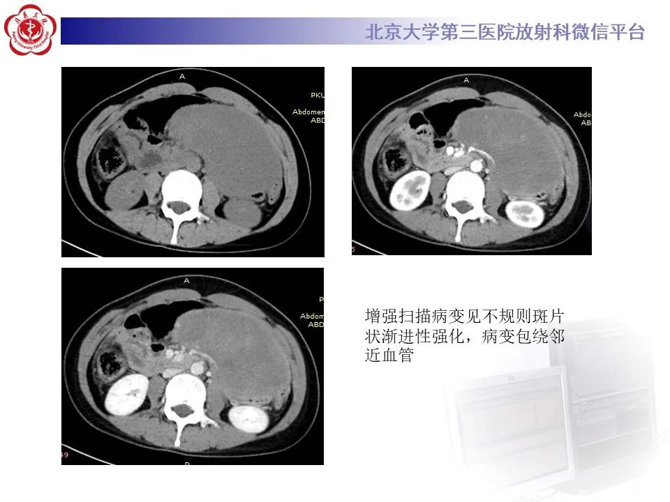 影像PPT - 【PPT】侵袭性纤维瘤病（腹内型）-4