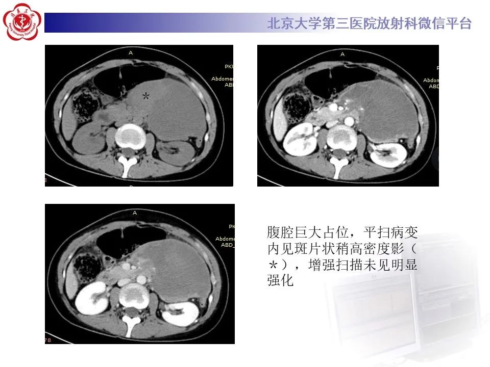 影像PPT - 【PPT】侵袭性纤维瘤病（腹内型）-3