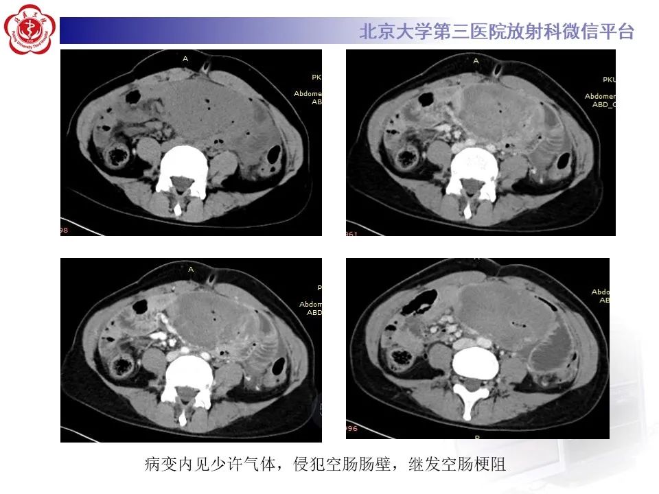 影像PPT - 【PPT】侵袭性纤维瘤病（腹内型）-5