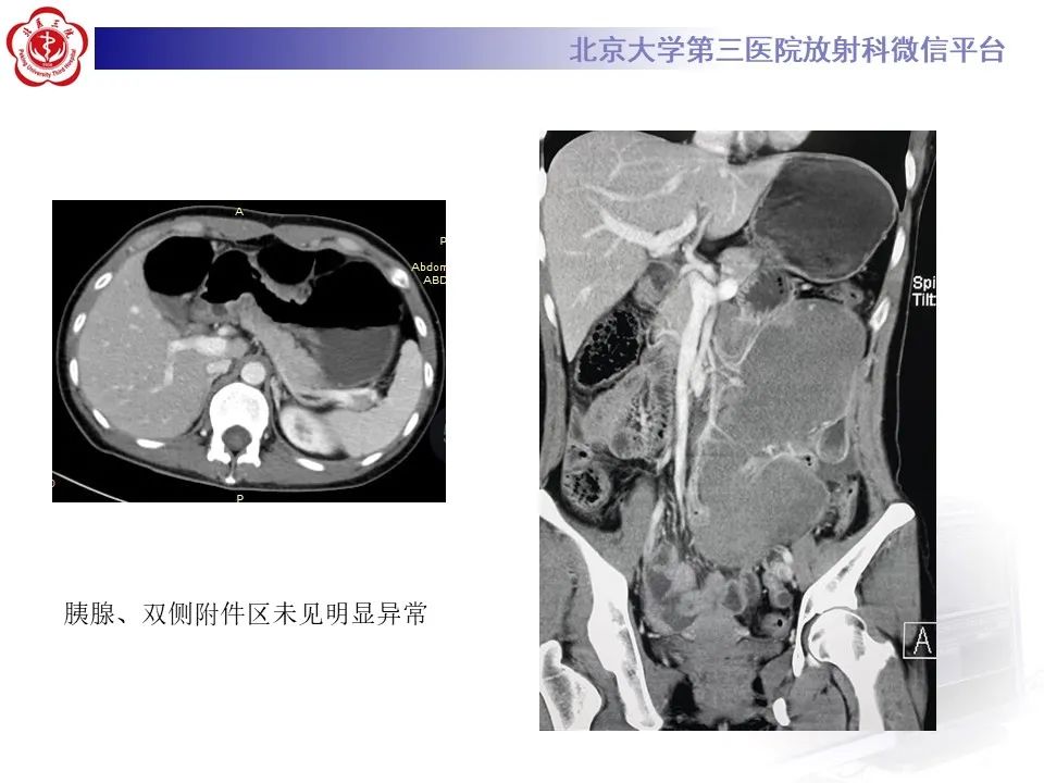 影像PPT - 【PPT】侵袭性纤维瘤病（腹内型）-6