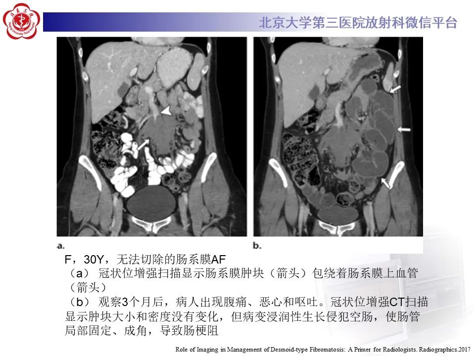 影像PPT - 【PPT】侵袭性纤维瘤病（腹内型）-17