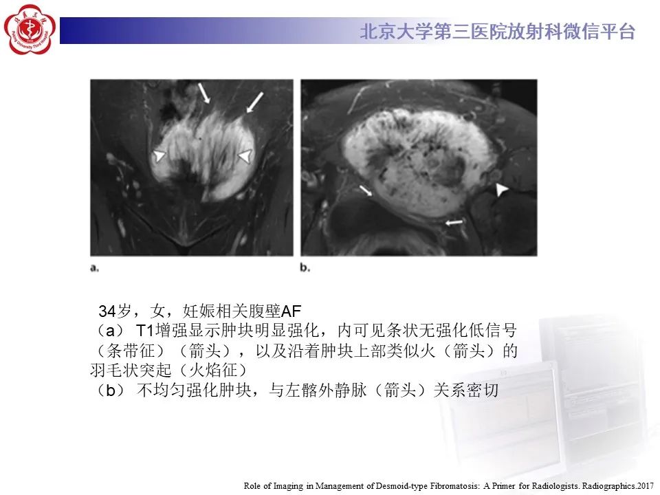 影像PPT - 【PPT】侵袭性纤维瘤病（腹内型）-20