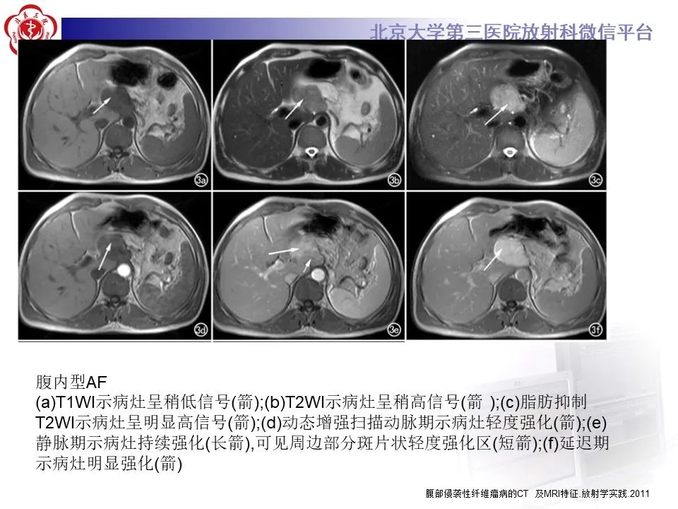 影像PPT - 【PPT】侵袭性纤维瘤病（腹内型）-21