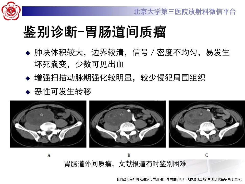 影像PPT - 【PPT】侵袭性纤维瘤病（腹内型）-23