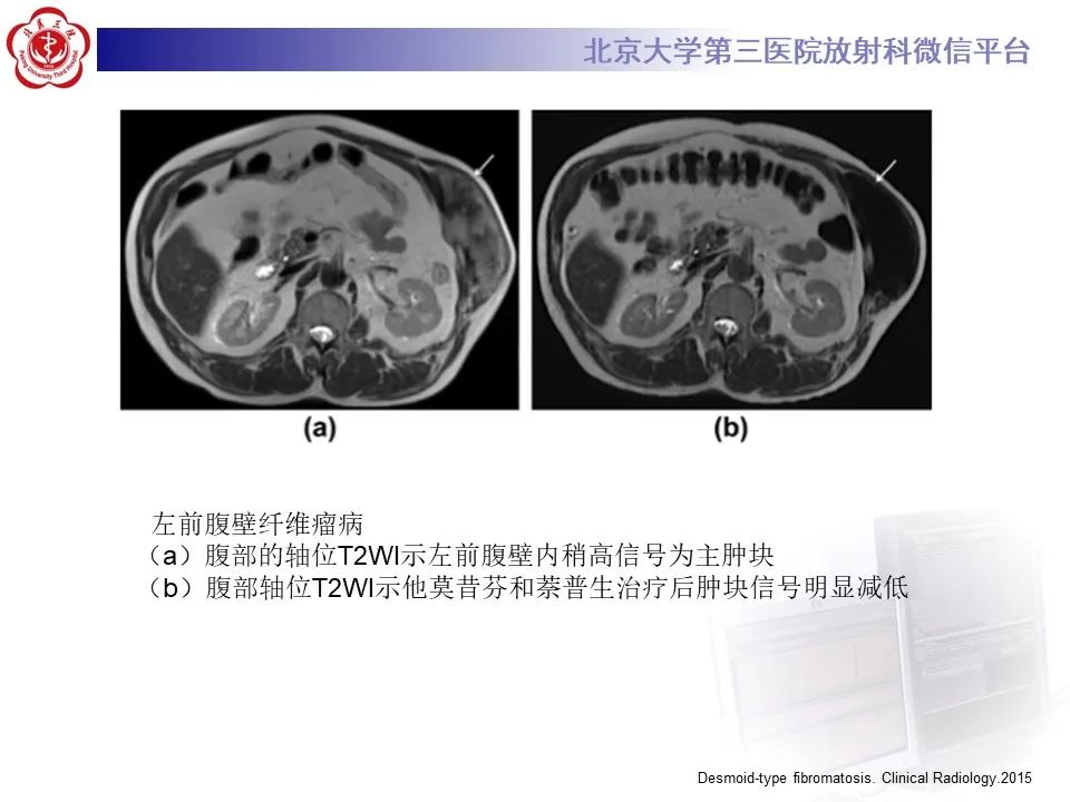 影像PPT - 【PPT】侵袭性纤维瘤病（腹内型）-29