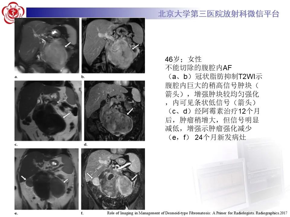影像PPT - 【PPT】侵袭性纤维瘤病（腹内型）-30