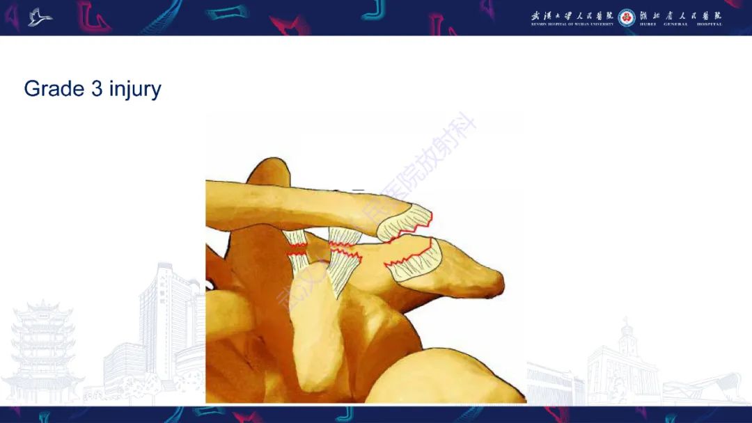影像PPT - 【PPT】肩锁关节病变影像诊断-18