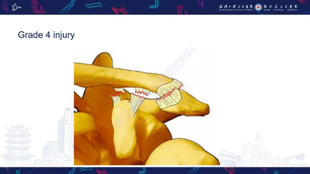影像PPT - 【PPT】肩锁关节病变影像诊断-21
