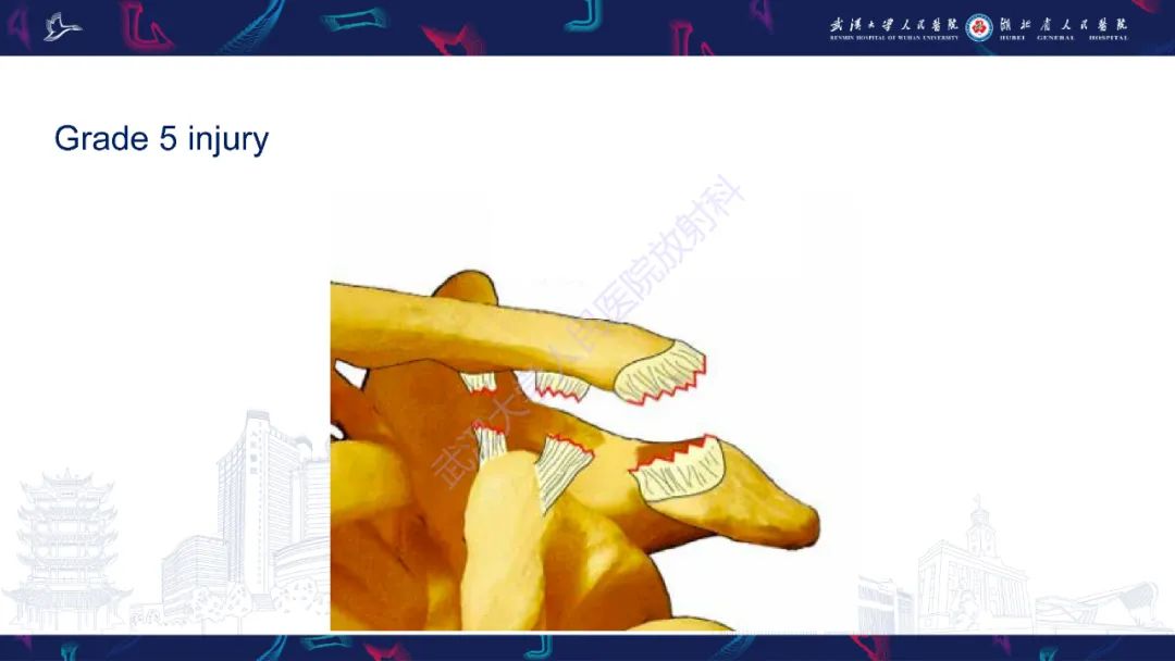 影像PPT - 【PPT】肩锁关节病变影像诊断-24