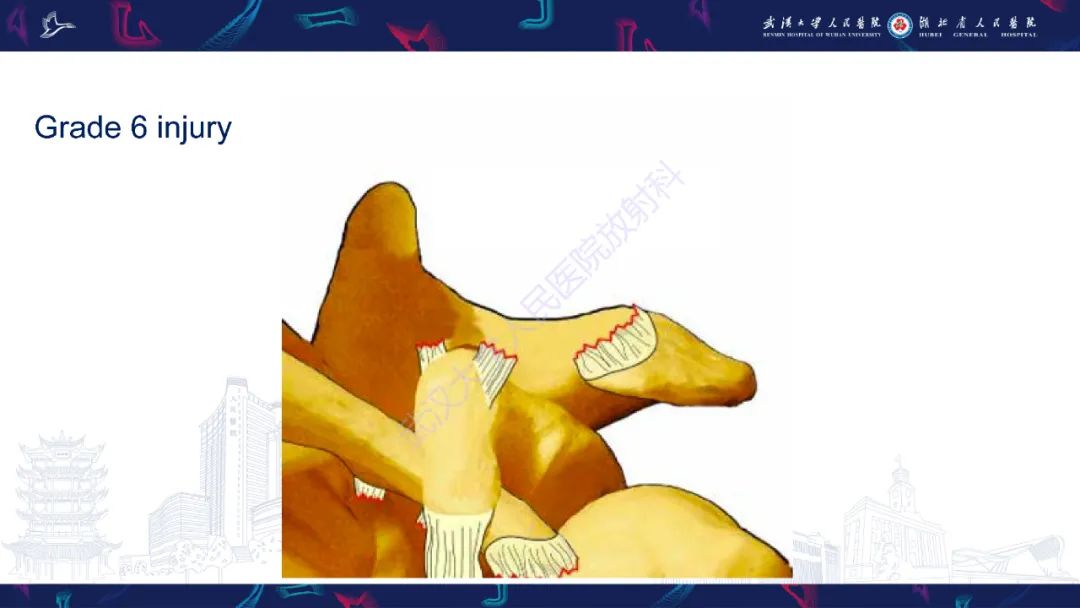 影像PPT - 【PPT】肩锁关节病变影像诊断-27