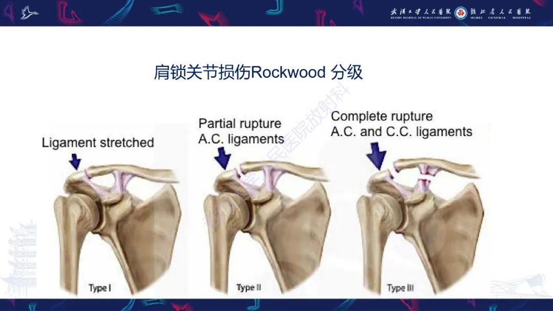 影像PPT - 【PPT】肩锁关节病变影像诊断-28
