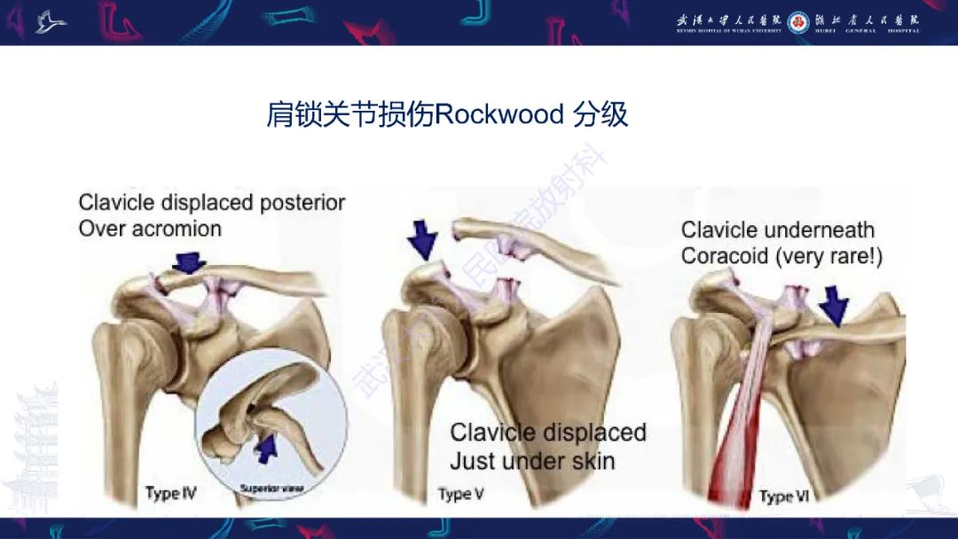 影像PPT - 【PPT】肩锁关节病变影像诊断-29