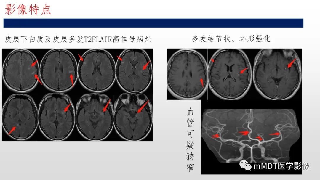 影像PPT - 【PPT】神经白塞病NBD-6
