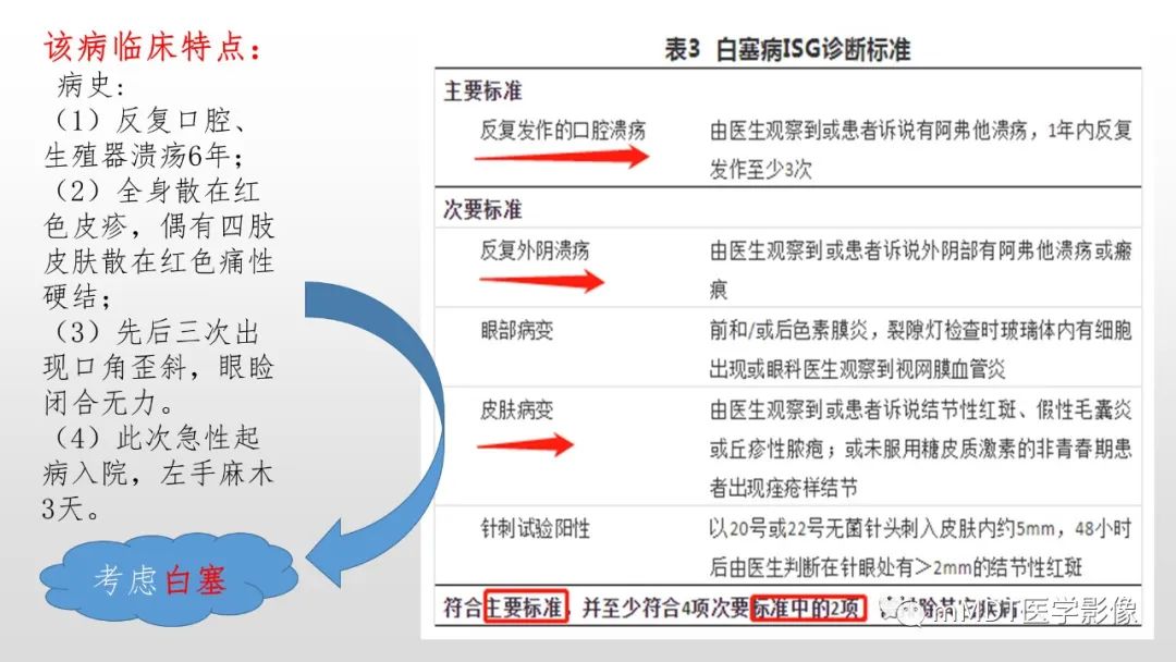 影像PPT - 【PPT】神经白塞病NBD-9