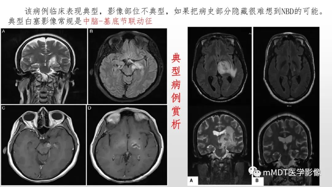 影像PPT - 【PPT】神经白塞病NBD-11