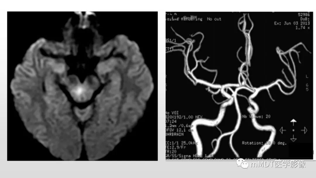 影像PPT - 【PPT】神经白塞病NBD-15