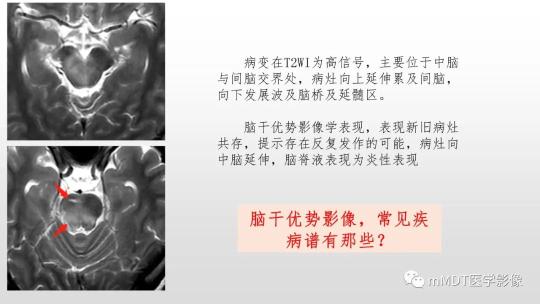 影像PPT - 【PPT】神经白塞病NBD-16