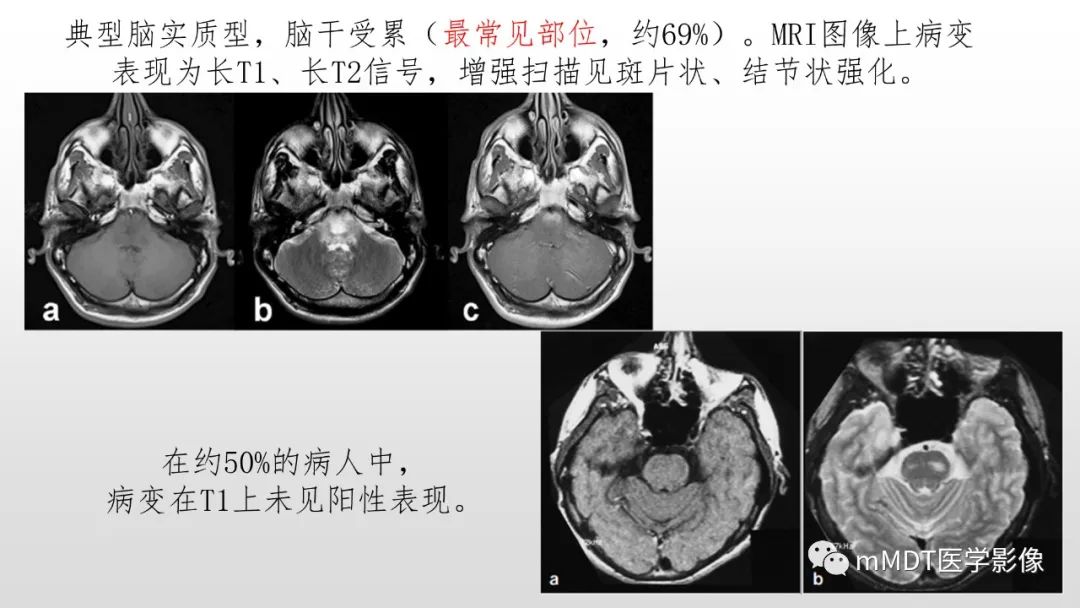 影像PPT - 【PPT】神经白塞病NBD-27