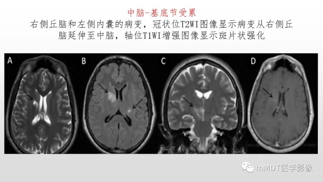 影像PPT - 【PPT】神经白塞病NBD-28