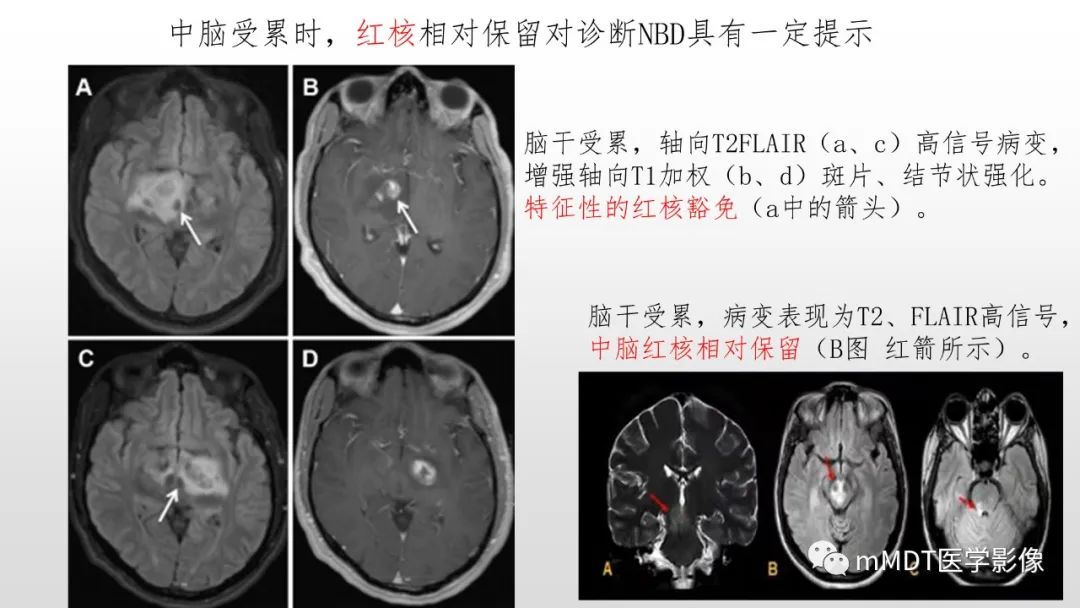 影像PPT - 【PPT】神经白塞病NBD-30