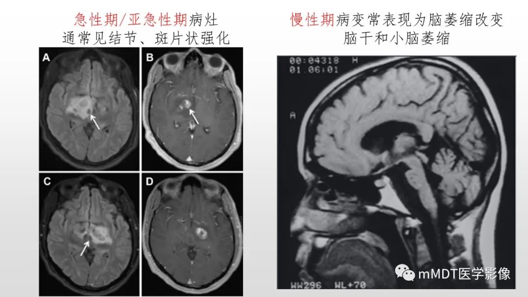 影像PPT - 【PPT】神经白塞病NBD-29