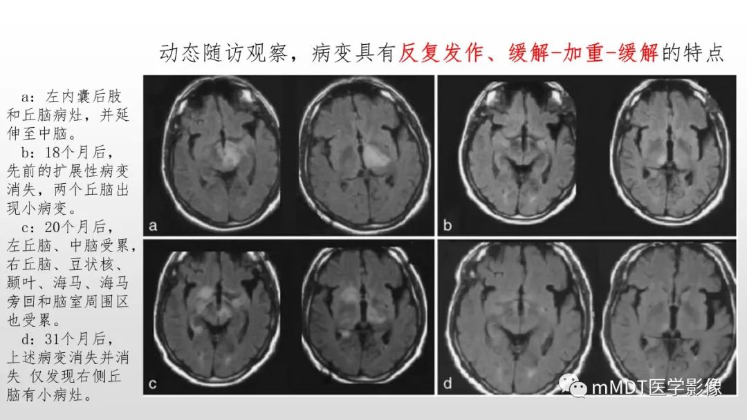 影像PPT - 【PPT】神经白塞病NBD-31