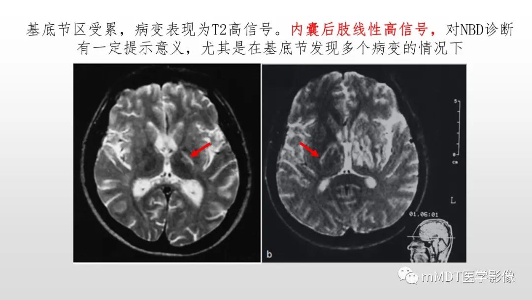 影像PPT - 【PPT】神经白塞病NBD-32