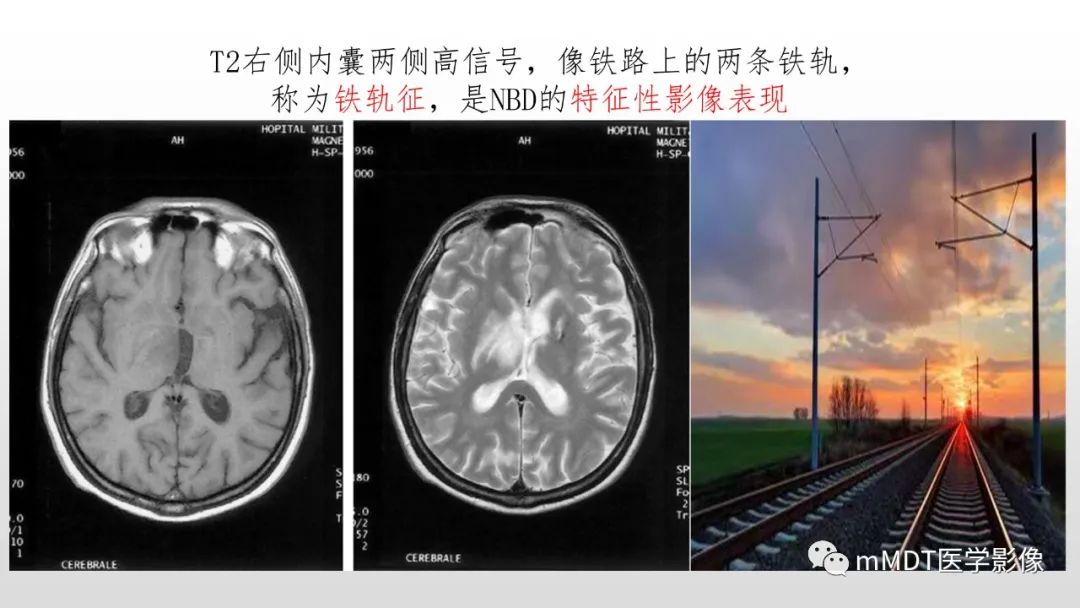 影像PPT - 【PPT】神经白塞病NBD-33