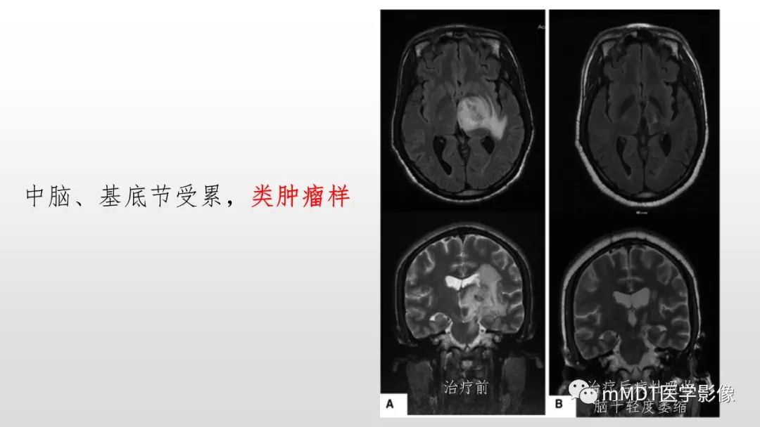 影像PPT - 【PPT】神经白塞病NBD-35
