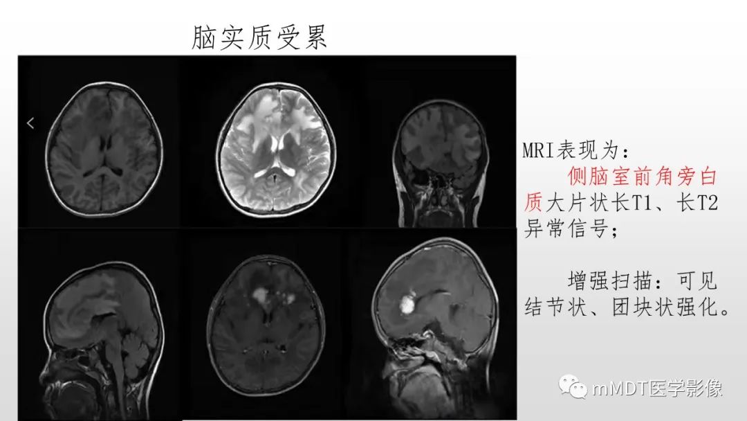 影像PPT - 【PPT】神经白塞病NBD-34