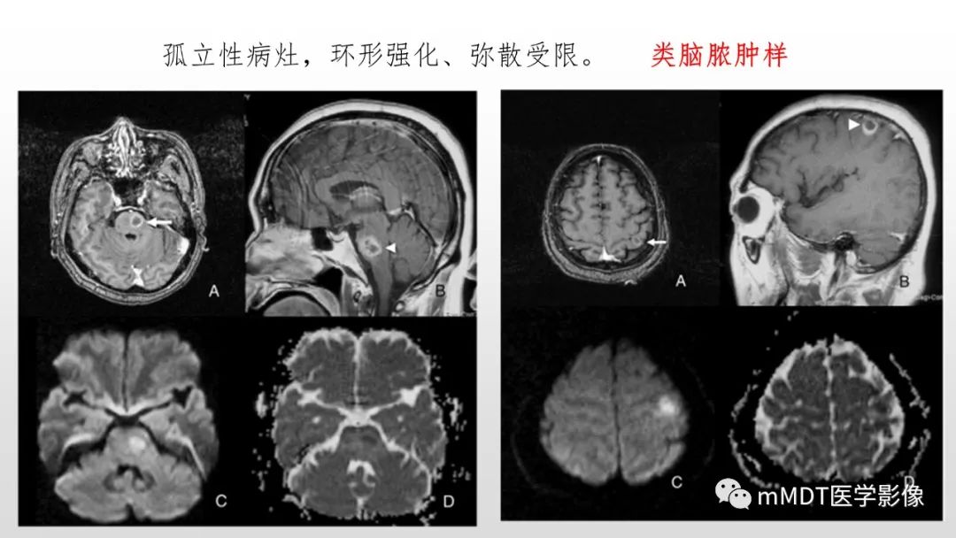 影像PPT - 【PPT】神经白塞病NBD-36