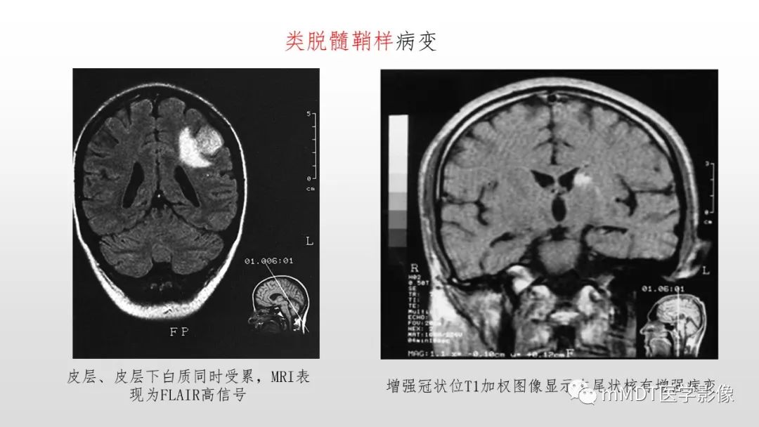 影像PPT - 【PPT】神经白塞病NBD-37