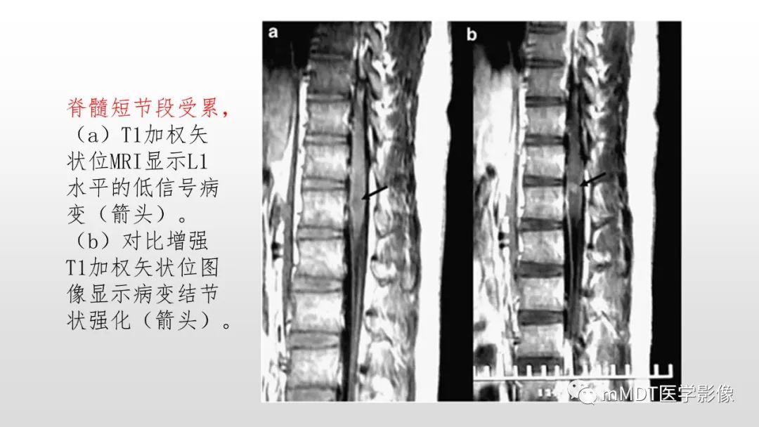 影像PPT - 【PPT】神经白塞病NBD-39